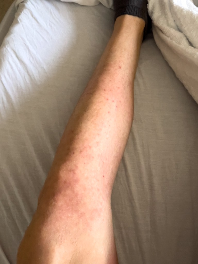 Folliculitis - Day +2