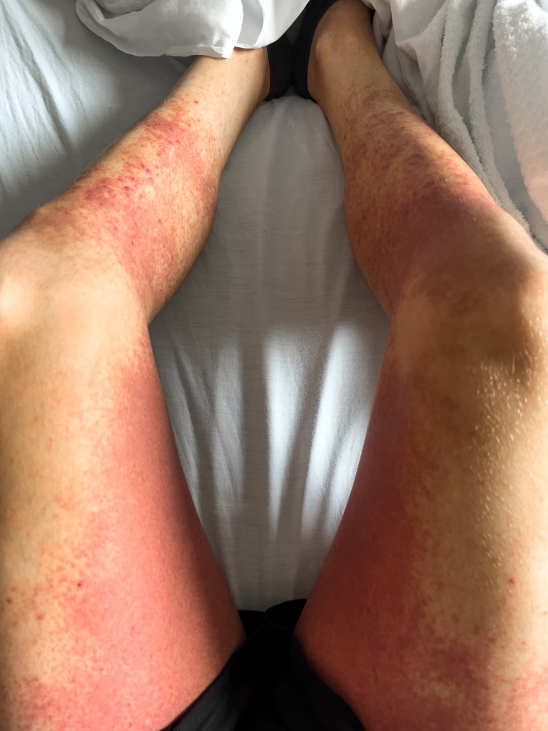 skin rash from drug