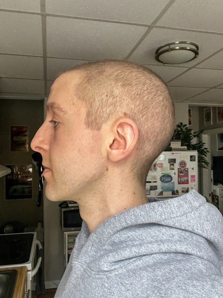 Hair regrowth update day +146