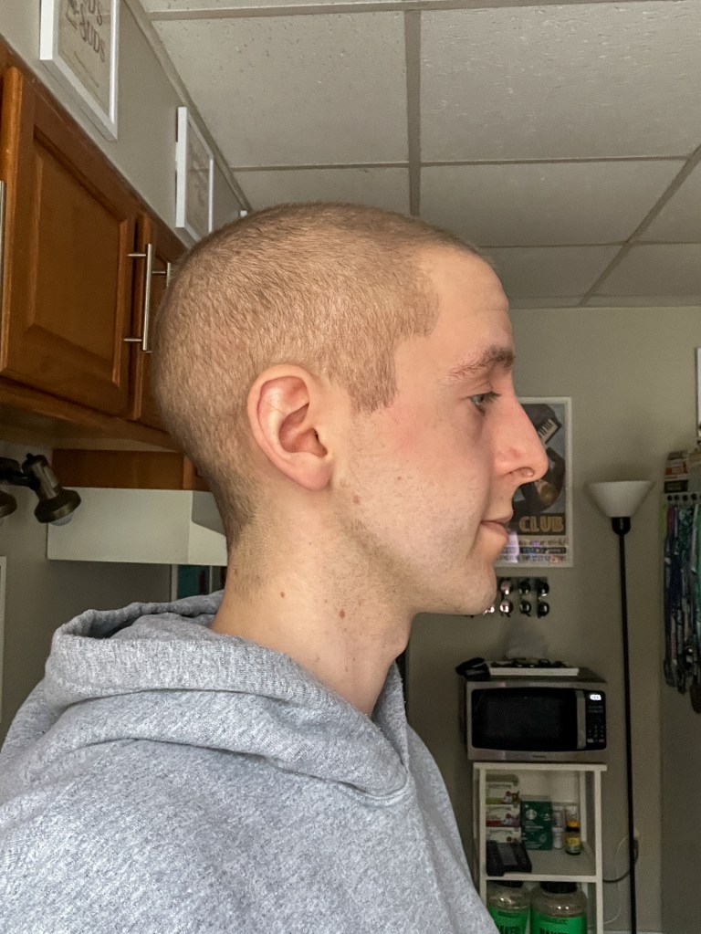 Hair regrowth update day +146