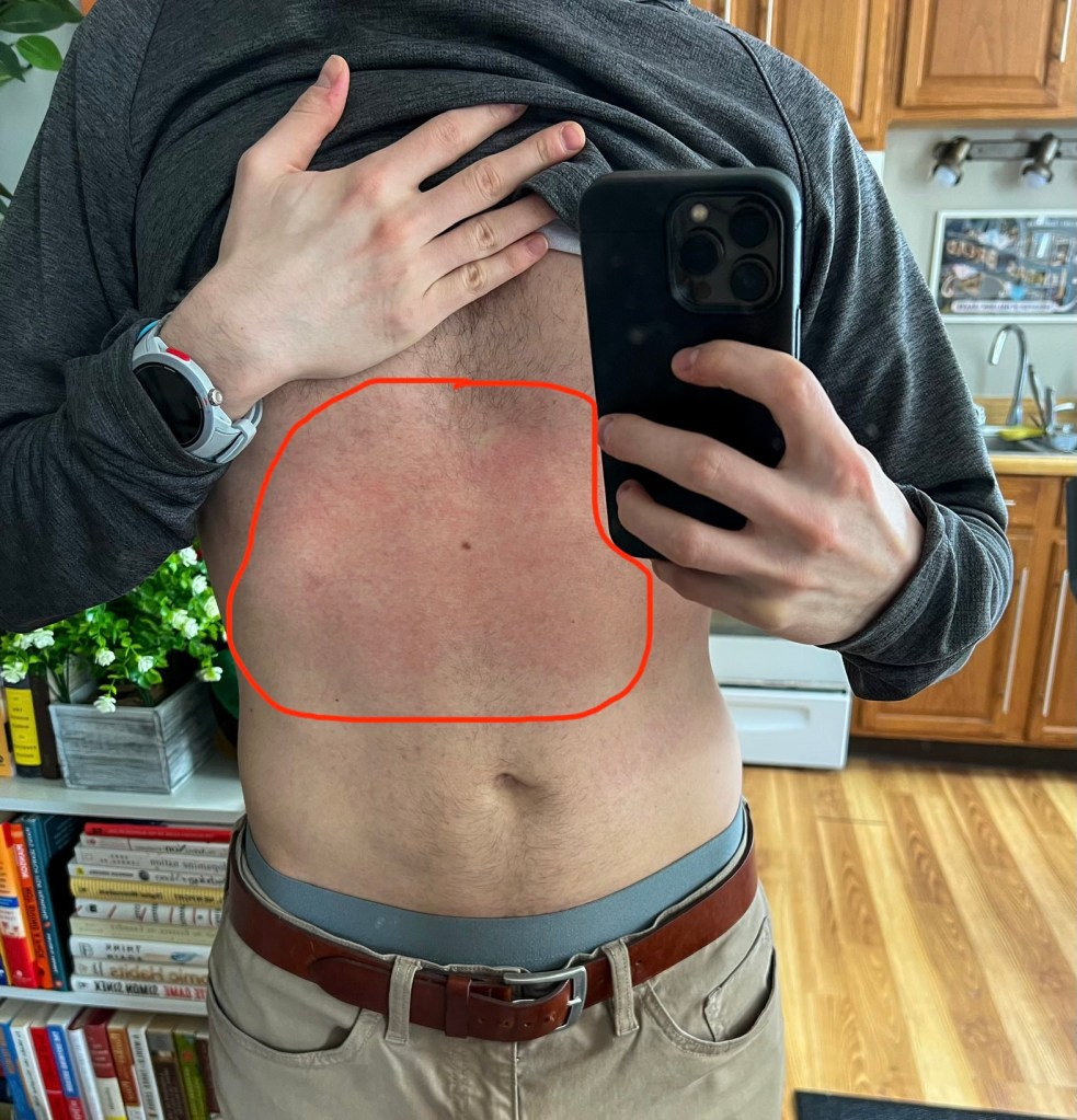 Stomach rash day +198 