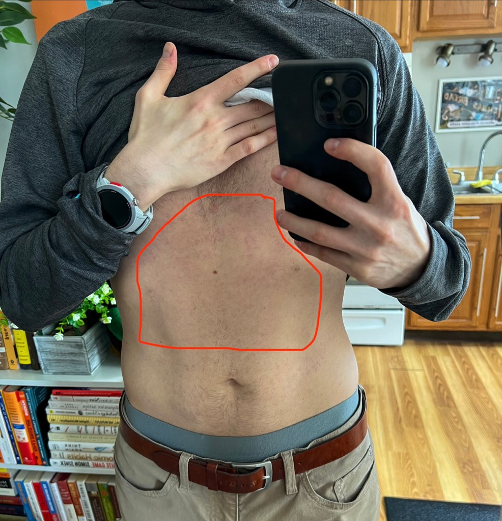 Stomach rash day +198 after hydrocortisone application