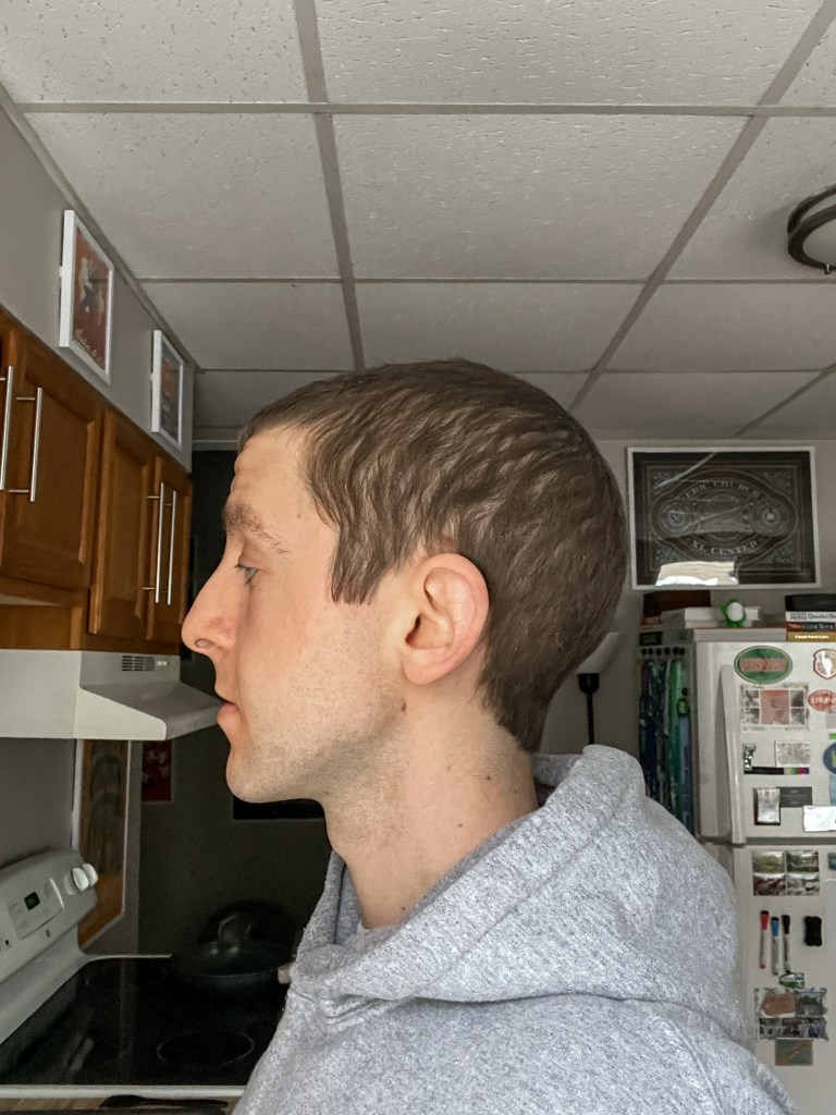 Hair regrowth day +199