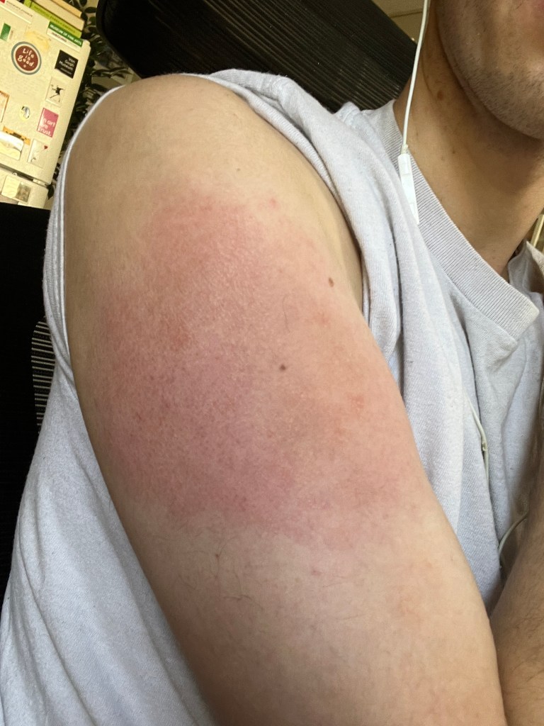 Inflammation caused by one year vaccinations